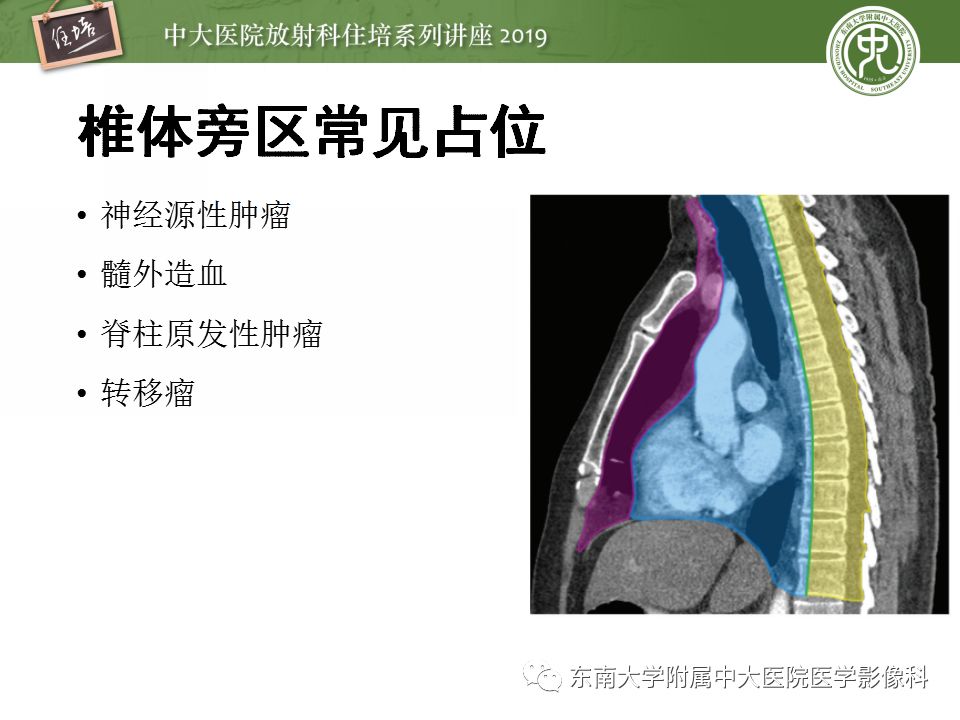 【PPT】纵隔分区及常见纵隔占位的影像诊断