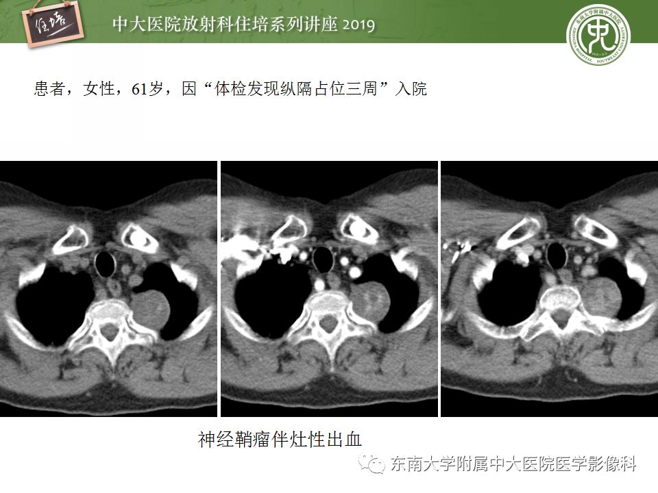 【PPT】纵隔分区及常见纵隔占位的影像诊断