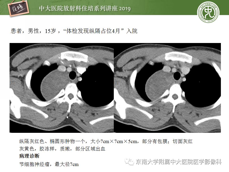【PPT】纵隔分区及常见纵隔占位的影像诊断