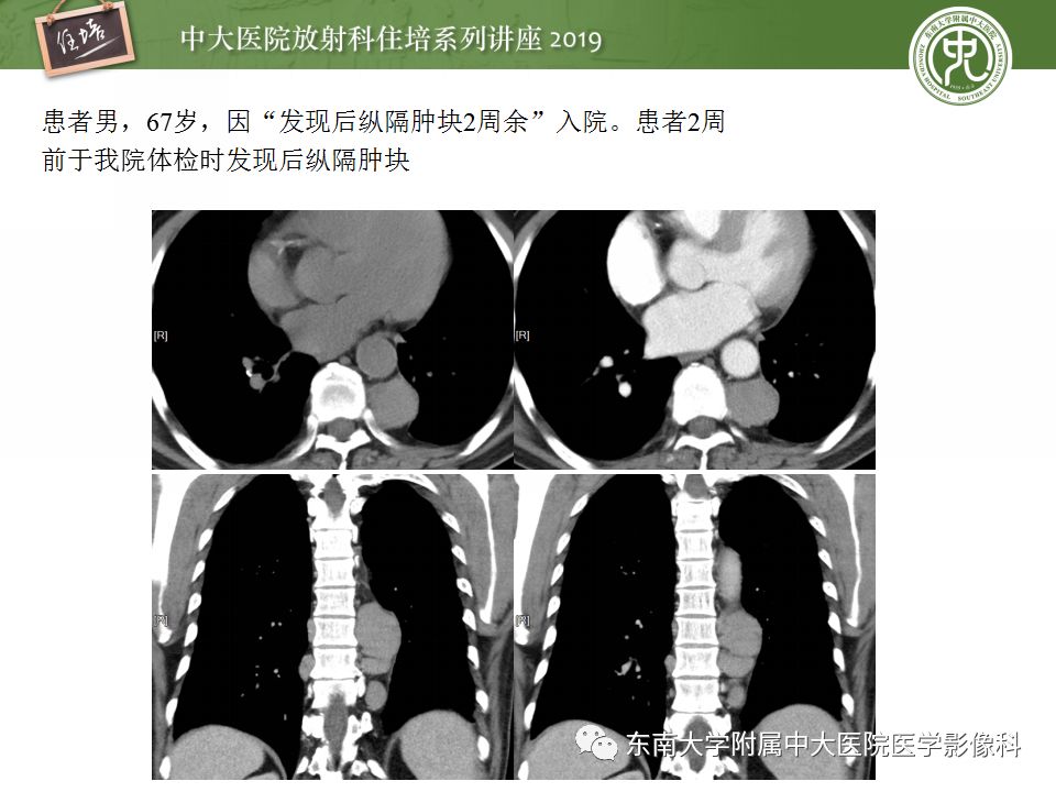 【PPT】纵隔分区及常见纵隔占位的影像诊断