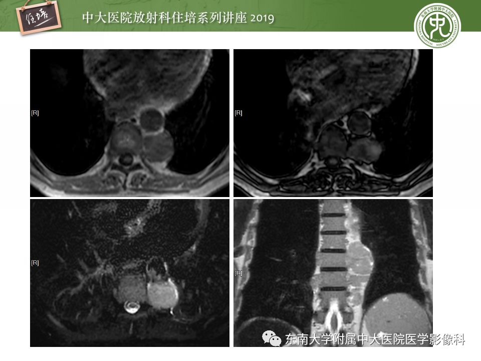 【PPT】纵隔分区及常见纵隔占位的影像诊断