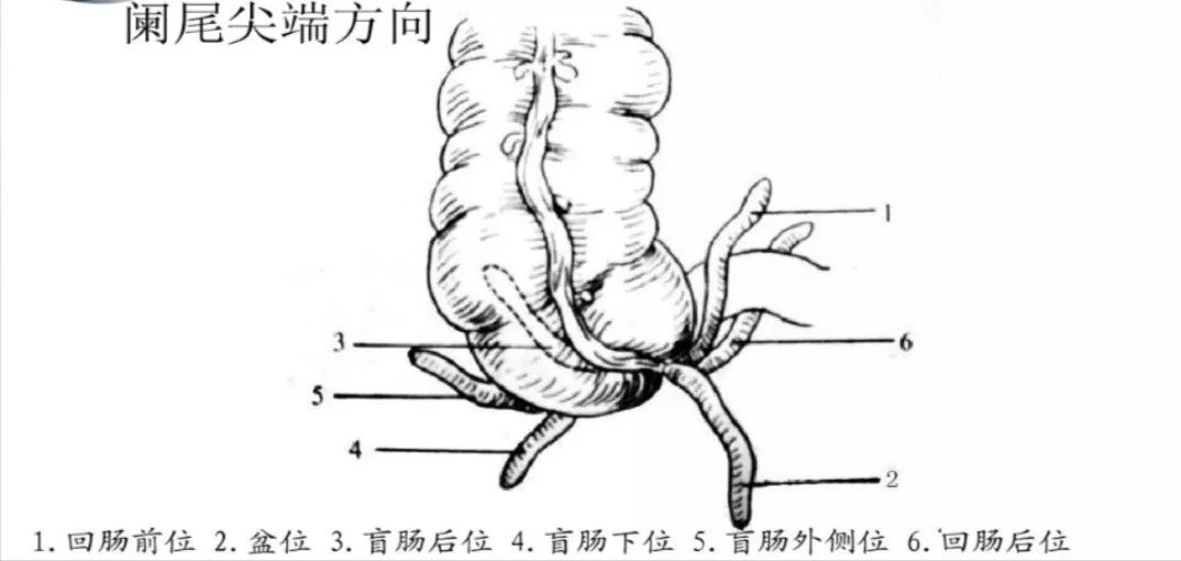 【病例】阑尾粘液性肿瘤1例CT影像表现 【病例】阑尾粘液性肿瘤1例CT影像表现