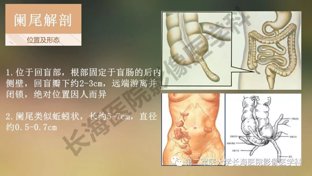 【PPT】阑尾常见原发肿瘤影像学表现