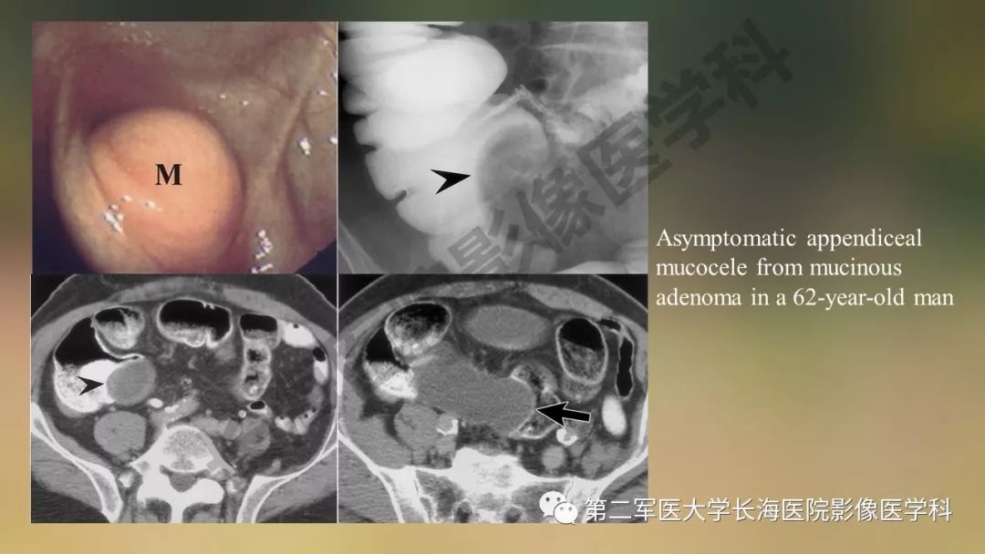 【PPT】阑尾常见原发肿瘤影像学表现