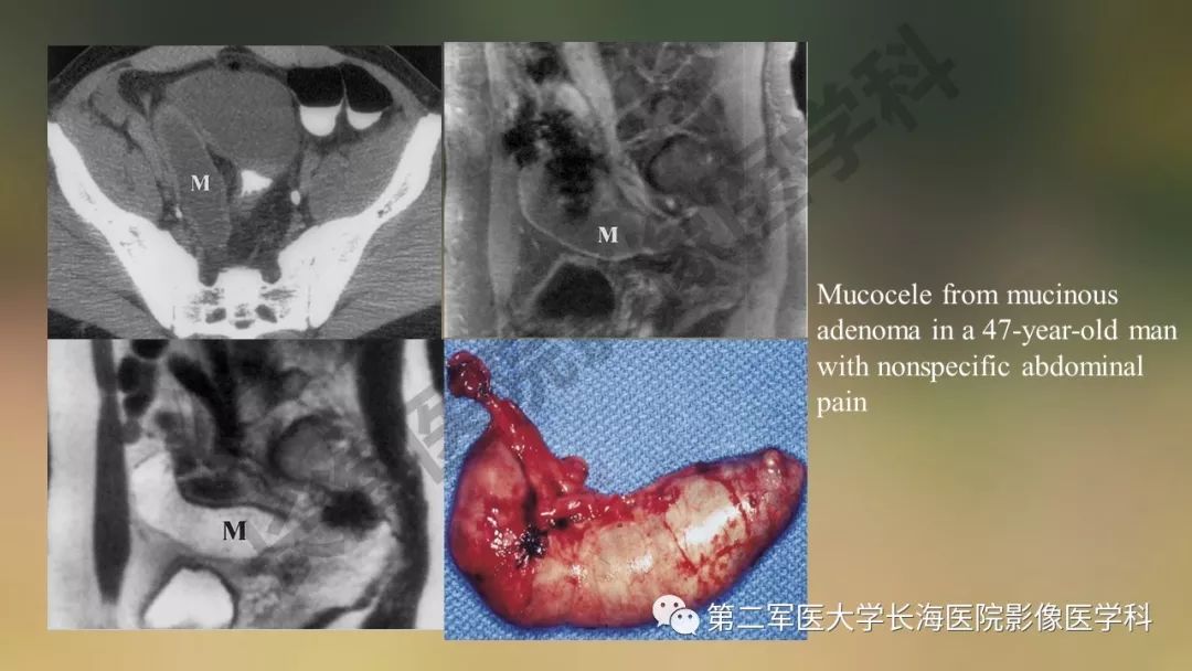 【PPT】阑尾常见原发肿瘤影像学表现