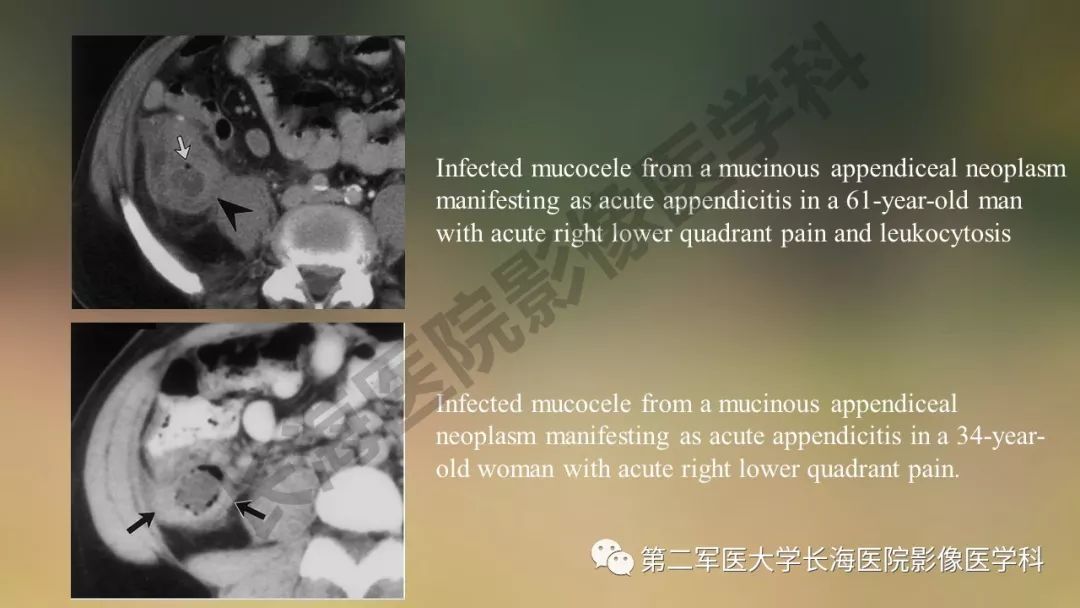 【PPT】阑尾常见原发肿瘤影像学表现