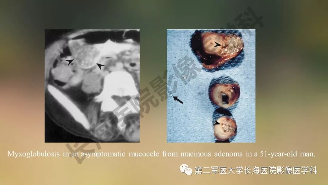 【PPT】阑尾常见原发肿瘤影像学表现