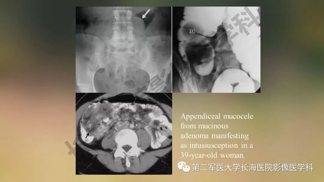 【PPT】阑尾常见原发肿瘤影像学表现