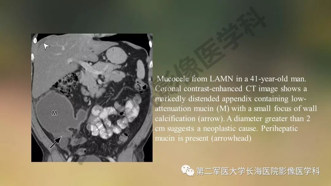 【PPT】阑尾常见原发肿瘤影像学表现