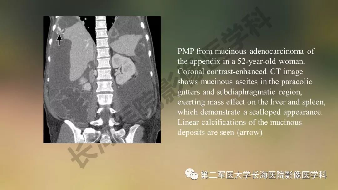 【PPT】阑尾常见原发肿瘤影像学表现