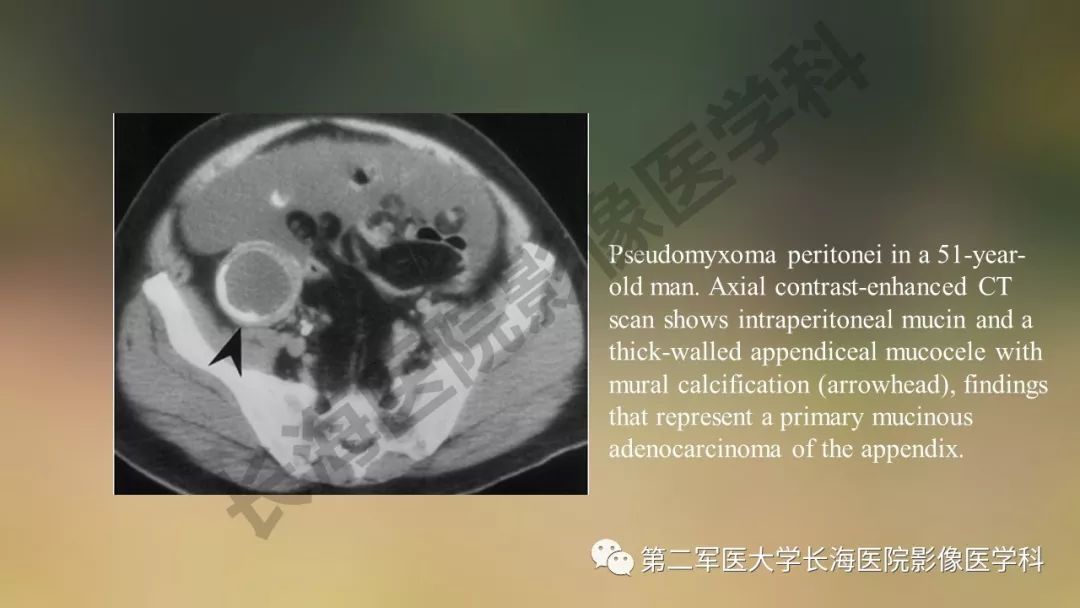 【PPT】阑尾常见原发肿瘤影像学表现