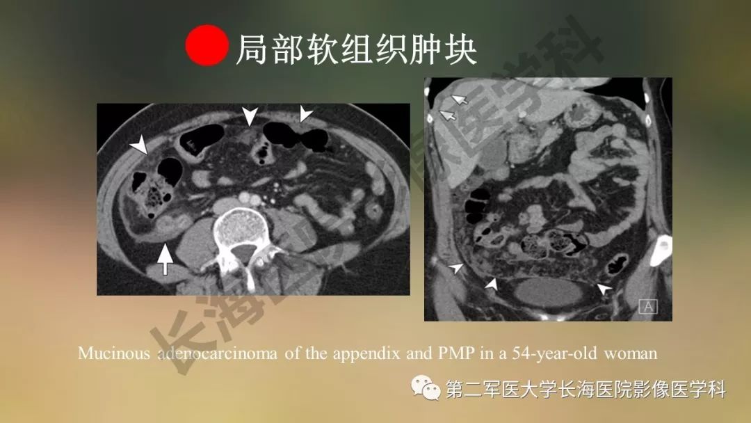 【PPT】阑尾常见原发肿瘤影像学表现