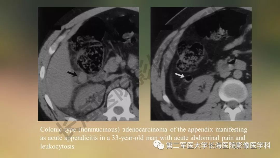 【PPT】阑尾常见原发肿瘤影像学表现