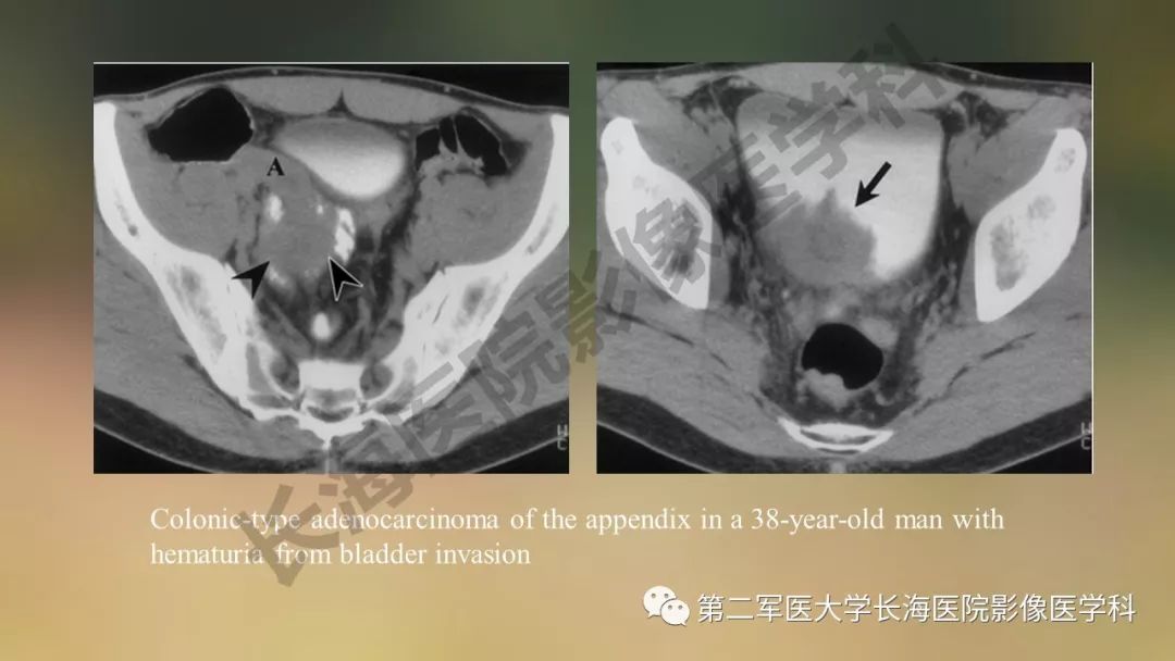 【PPT】阑尾常见原发肿瘤影像学表现