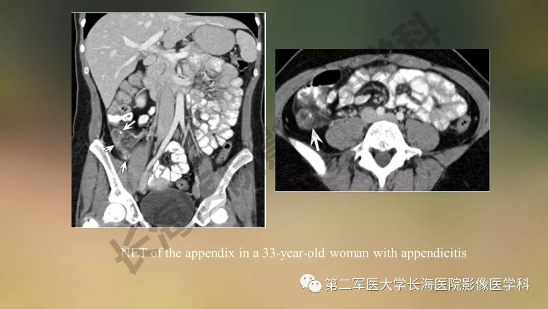 【PPT】阑尾常见原发肿瘤影像学表现
