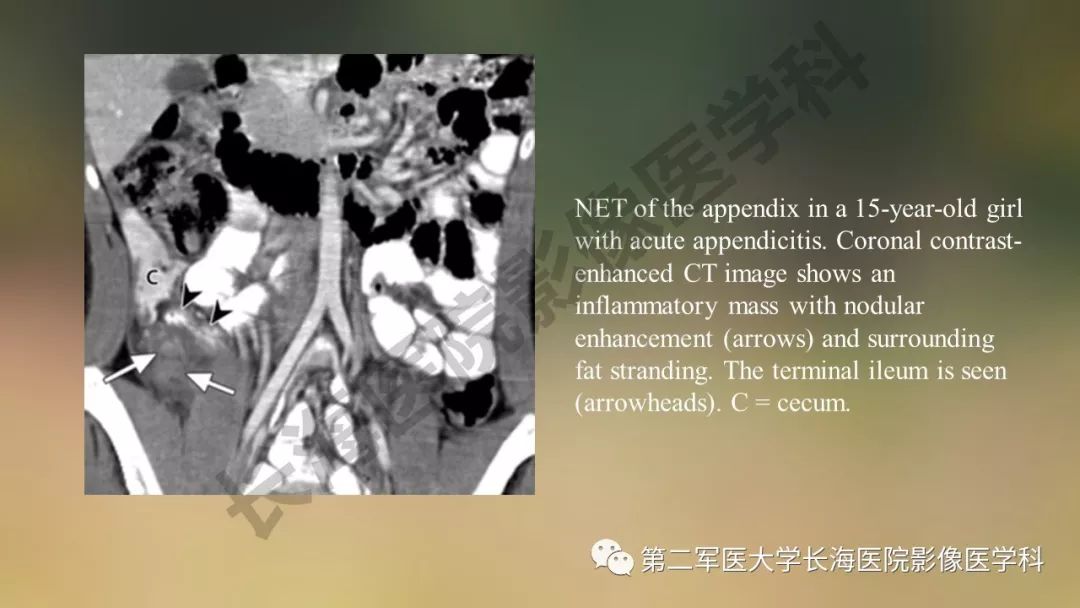【PPT】阑尾常见原发肿瘤影像学表现