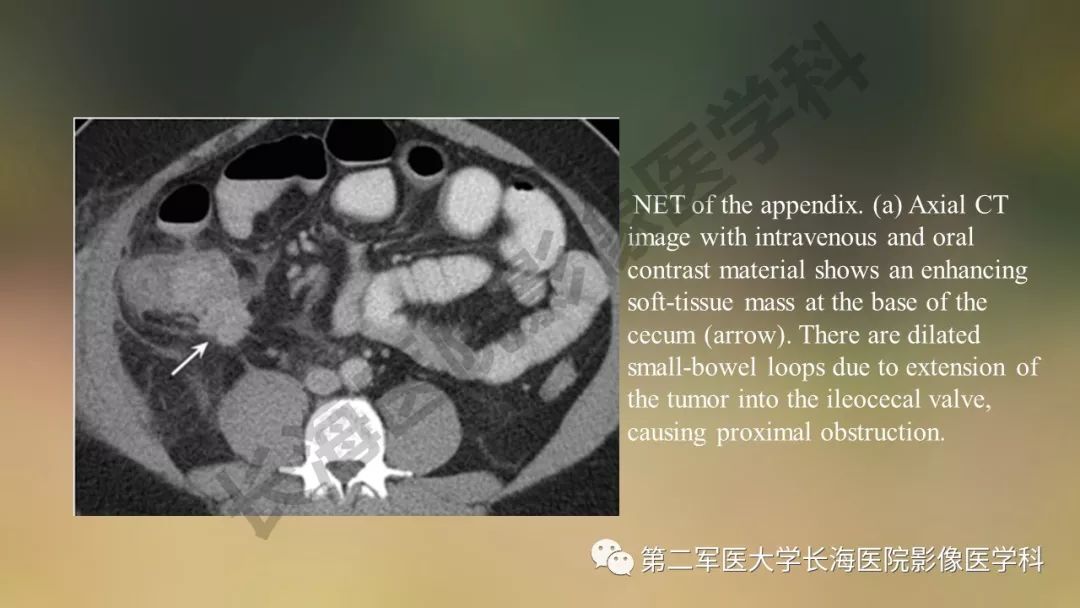 【PPT】阑尾常见原发肿瘤影像学表现