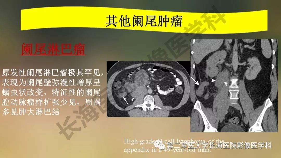 【PPT】阑尾常见原发肿瘤影像学表现