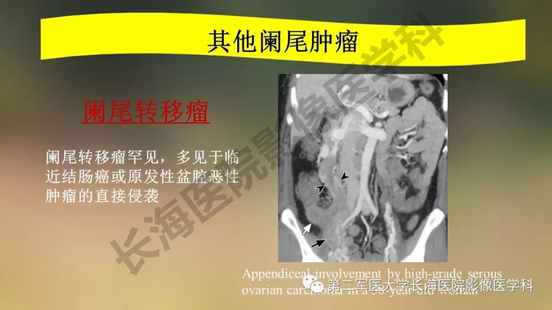 【PPT】阑尾常见原发肿瘤影像学表现