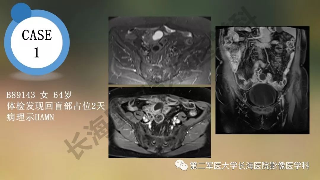 【PPT】阑尾常见原发肿瘤影像学表现