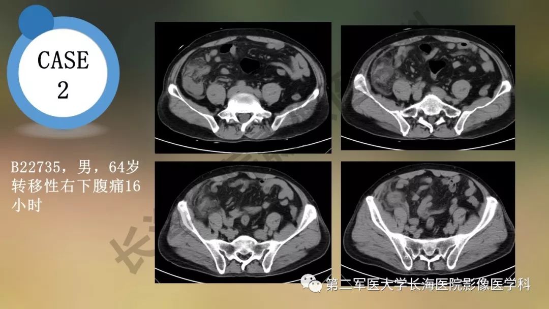 【PPT】阑尾常见原发肿瘤影像学表现
