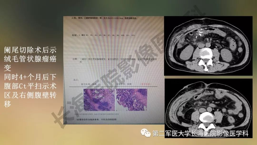 【PPT】阑尾常见原发肿瘤影像学表现