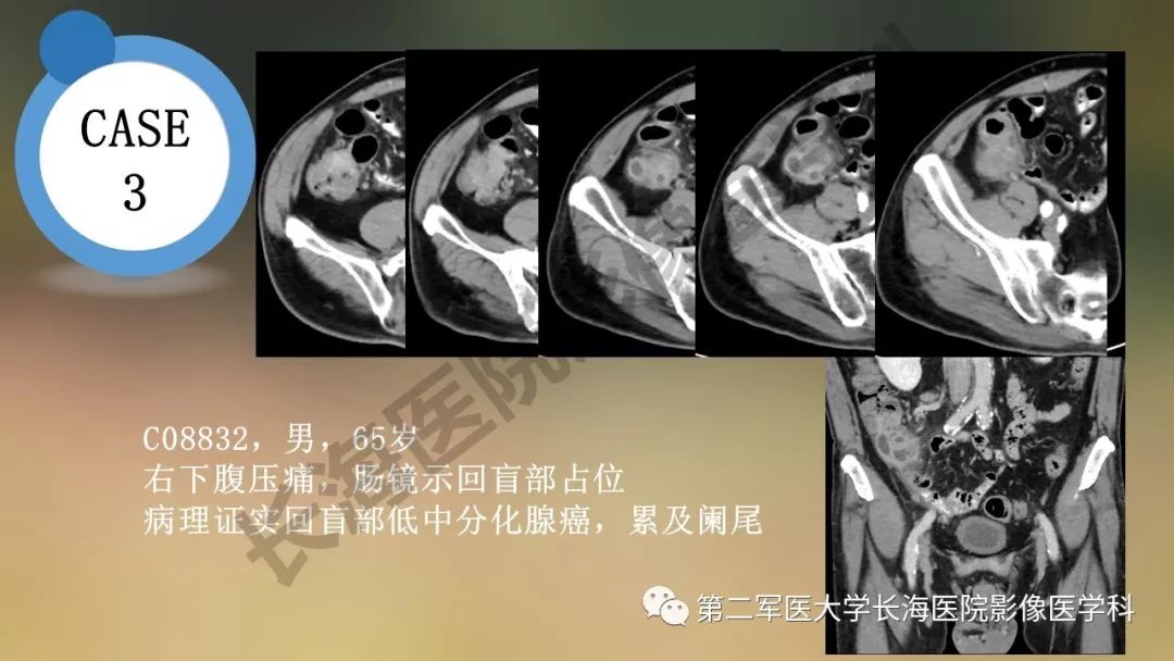 【PPT】阑尾常见原发肿瘤影像学表现