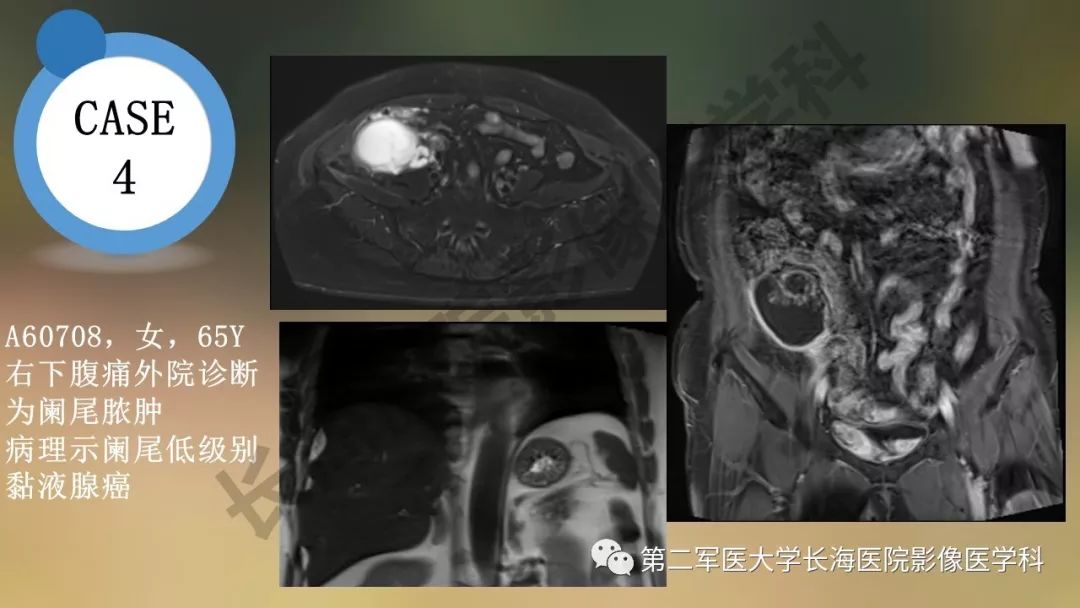 【PPT】阑尾常见原发肿瘤影像学表现