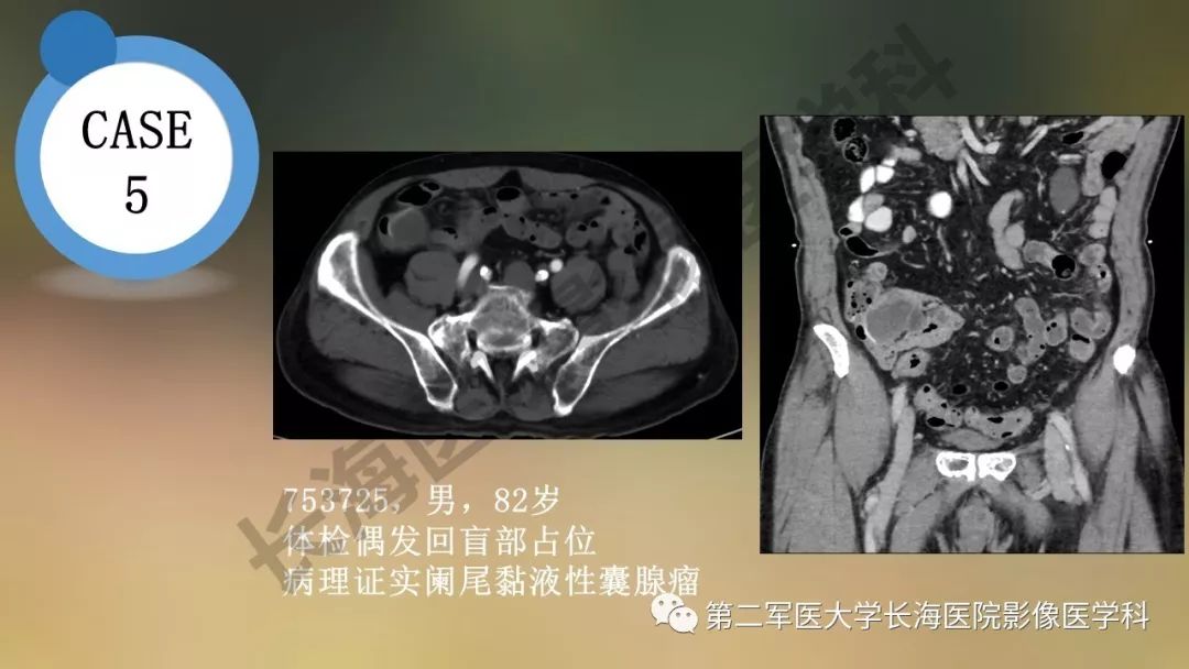 【PPT】阑尾常见原发肿瘤影像学表现