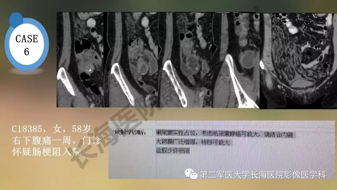 【PPT】阑尾常见原发肿瘤影像学表现