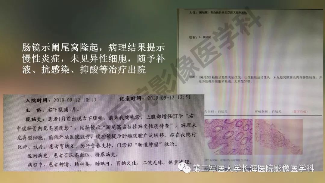 【PPT】阑尾常见原发肿瘤影像学表现