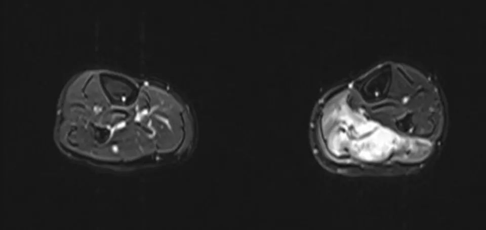 【病例】小腿腺泡状软组织肉瘤1例MR影像 【病例】小腿腺泡状软组织肉瘤1例MR影像
