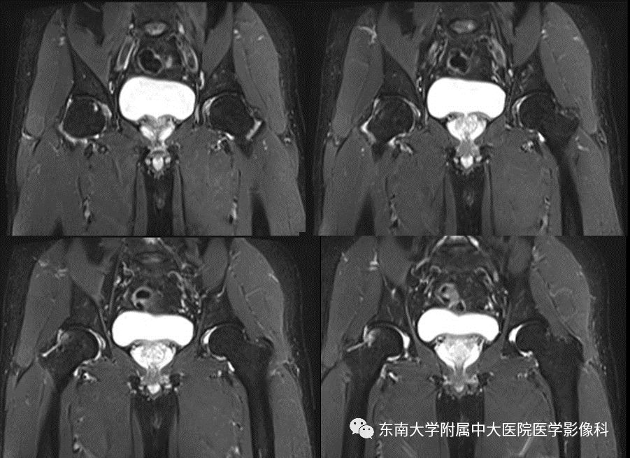 【病例】髋关节撞击综合征1例MR
