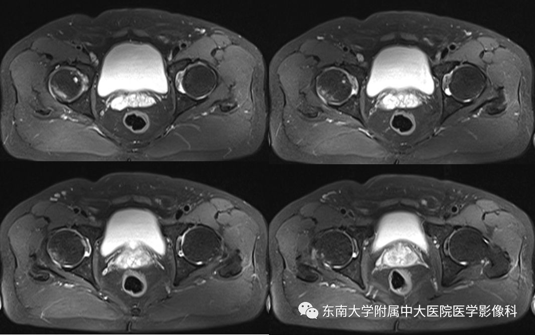 【病例】髋关节撞击综合征1例MR