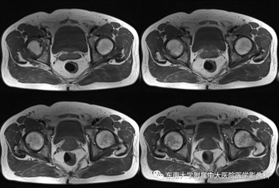 【病例】髋关节撞击综合征1例MR