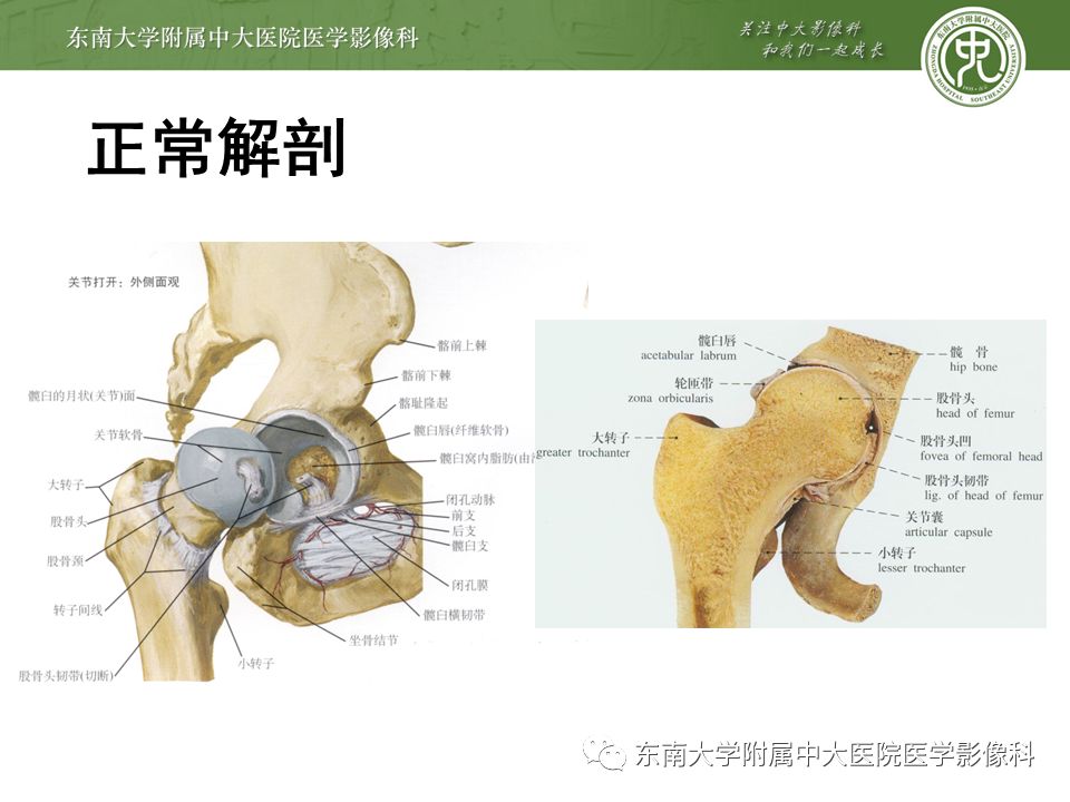 【病例】髋关节撞击综合征1例MR