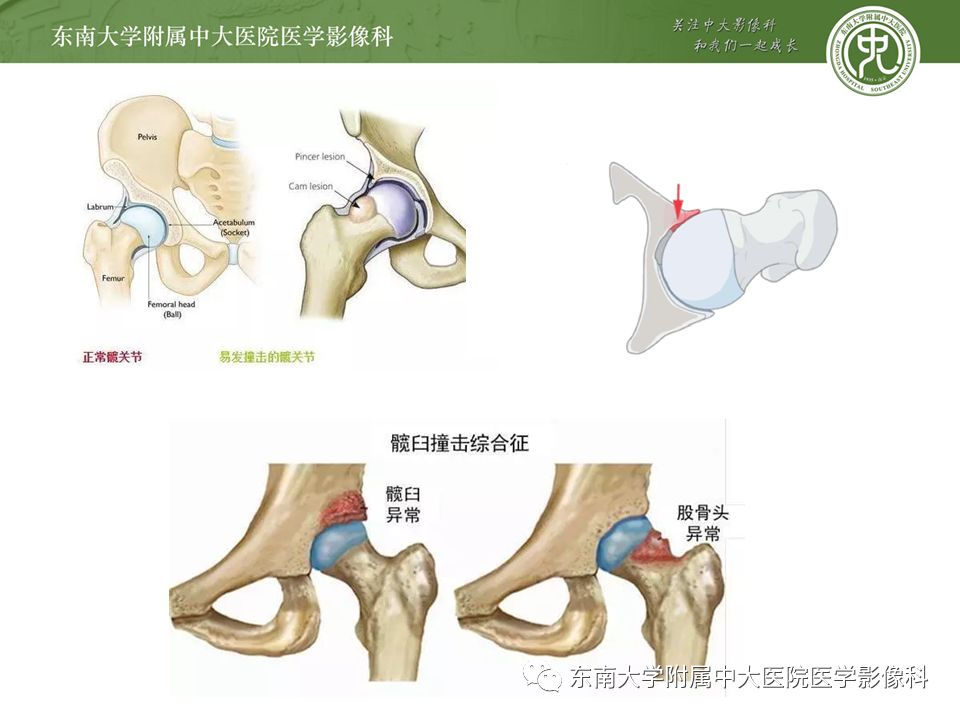 【病例】髋关节撞击综合征1例MR