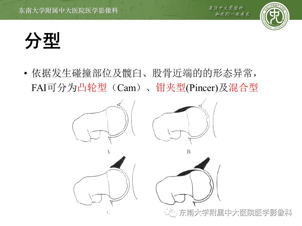 【病例】髋关节撞击综合征1例MR