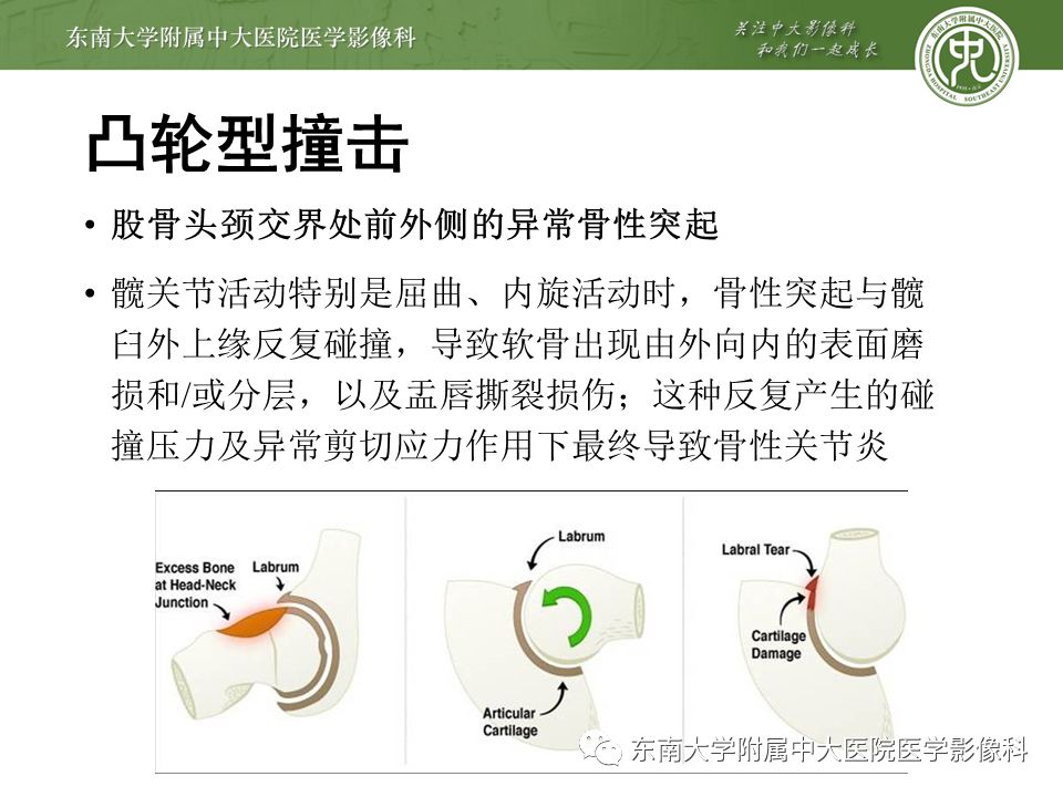 【病例】髋关节撞击综合征1例MR