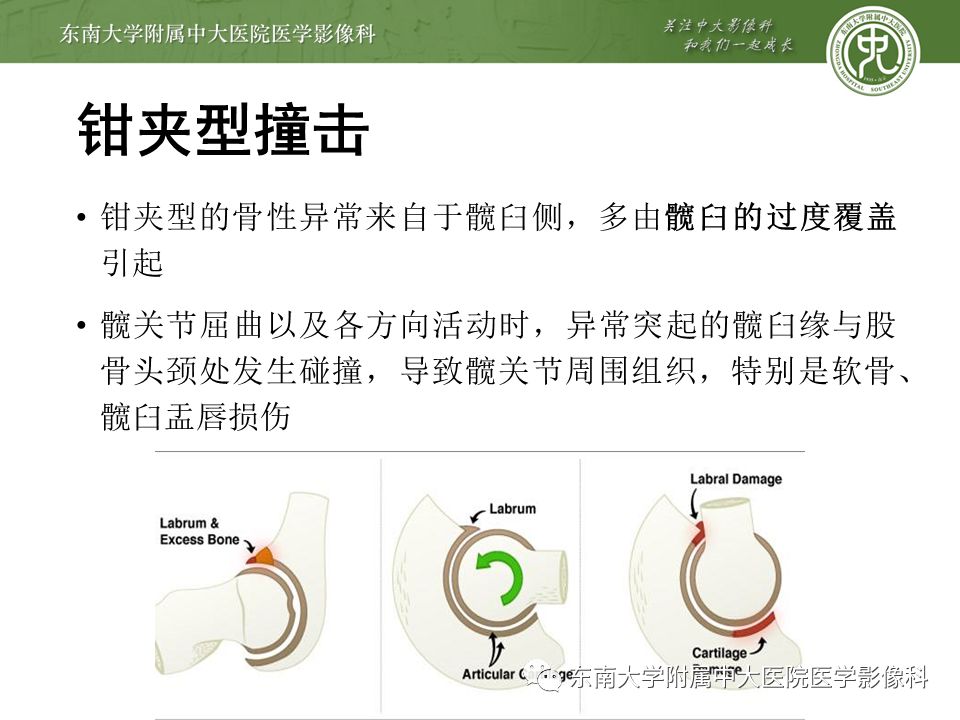 【病例】髋关节撞击综合征1例MR
