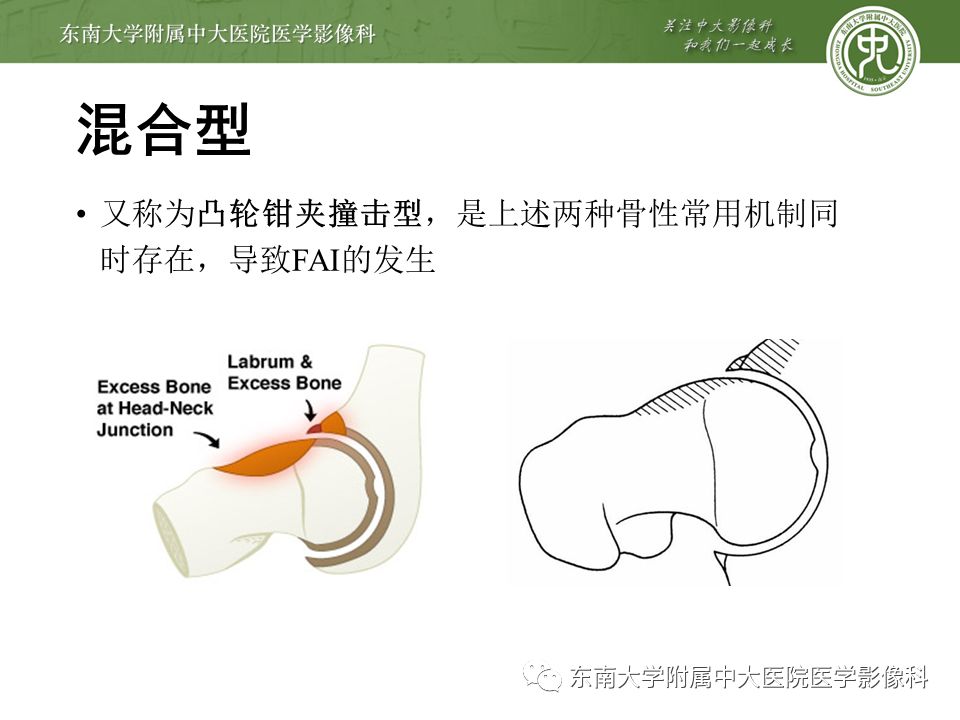 【病例】髋关节撞击综合征1例MR