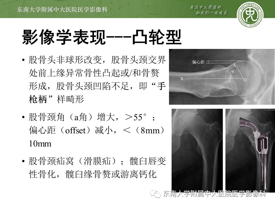 【病例】髋关节撞击综合征1例MR