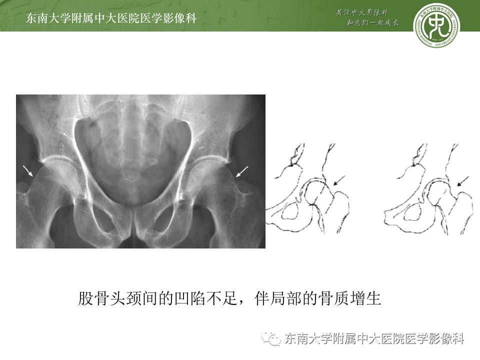 【病例】髋关节撞击综合征1例MR