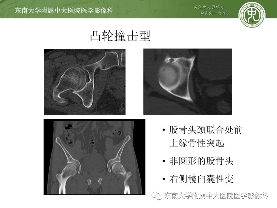 【病例】髋关节撞击综合征1例MR