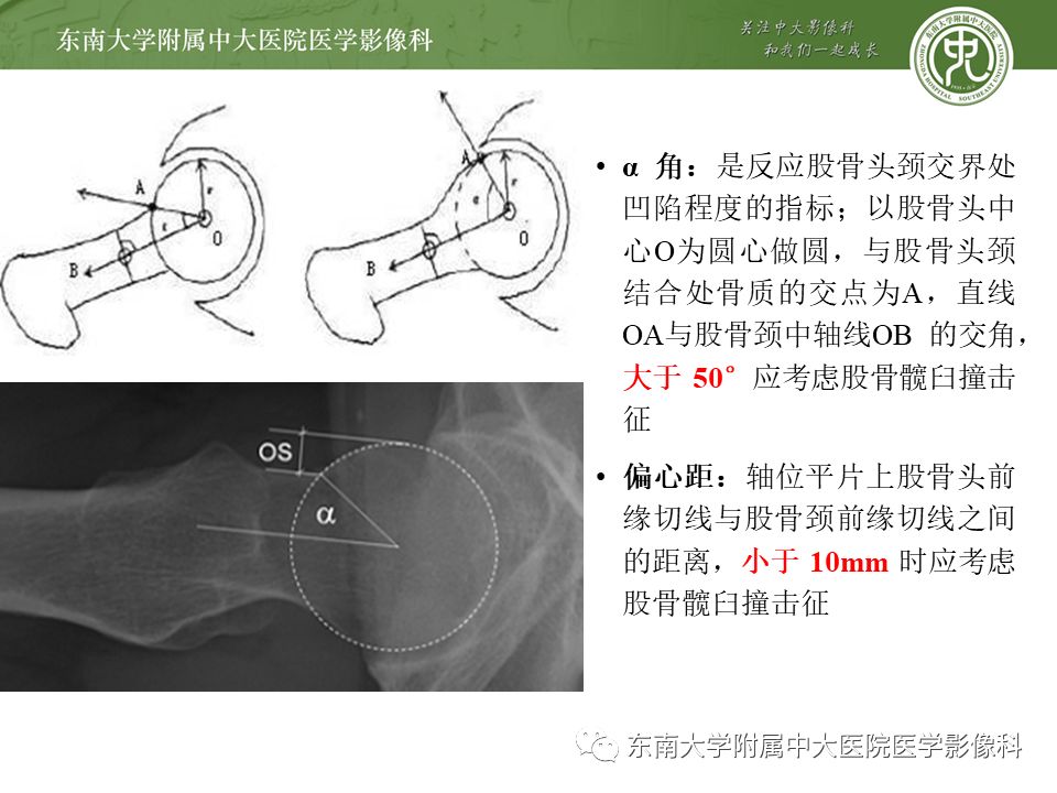 【病例】髋关节撞击综合征1例MR