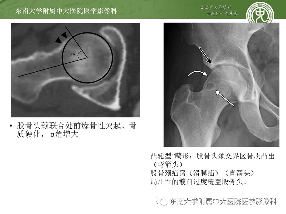 【病例】髋关节撞击综合征1例MR