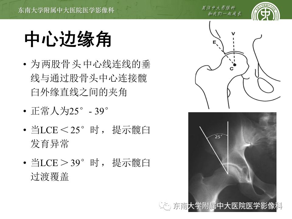 【病例】髋关节撞击综合征1例MR
