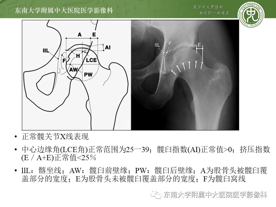 【病例】髋关节撞击综合征1例MR