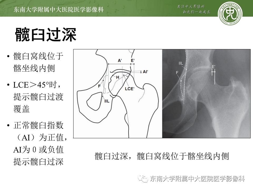 【病例】髋关节撞击综合征1例MR