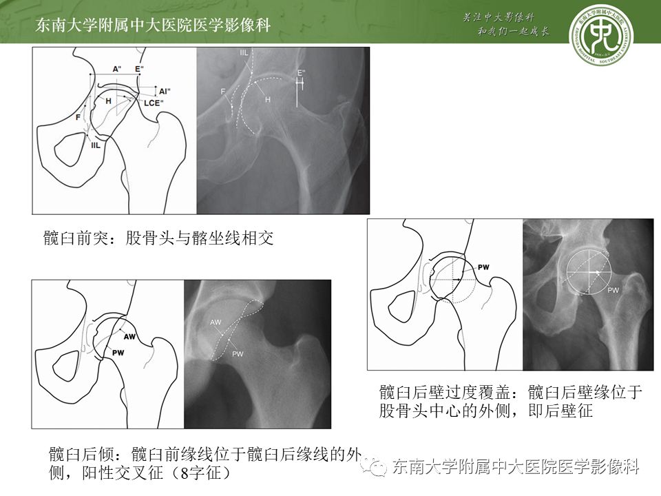 【病例】髋关节撞击综合征1例MR